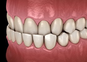 Digital rendering of an underbite 