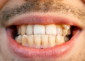 Close-up of man with crossbite 