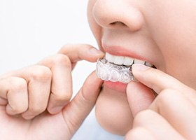 Teen girl putting on Invisalign tray
