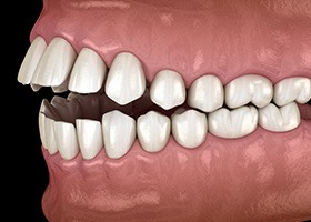 Digital rendering of an open bite 