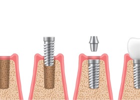 illustration of dental implant being placed  