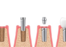 illustration of dental implant being placed