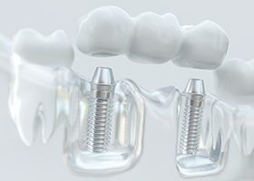 Implant dental bridge