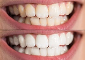 Close up of smile before and after teeth whitening