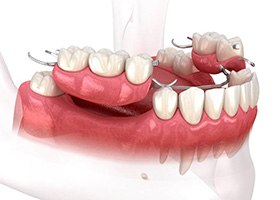 illustration of a partial denture