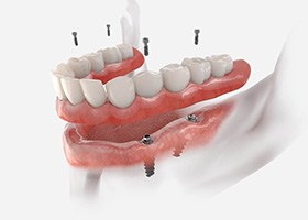 illustration of an implant denture