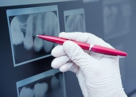 Pen pointing dental x rays