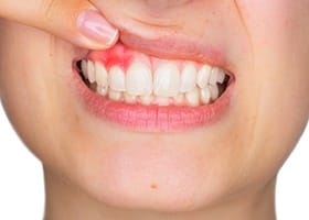 Close up of person pointing to red spot in their gums before gum disease treatment in Oklahoma City