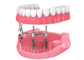 Illustration of implant dentures in Oklahoma City