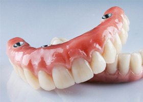 removable implant denture s