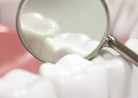 Close up of illustrated dental mirror reflecting tooth with porcelain inlay