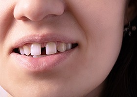 Close up of smile with gap between two front teeth
