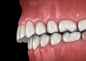 Illustrated mouth with overbite