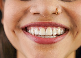 Close up of person smiling while wearing Invisalign tray