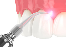 Digital rendering of laser gum recontouring 