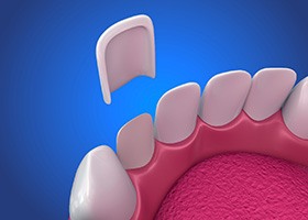 Illustrated veneer being placed over a tooth