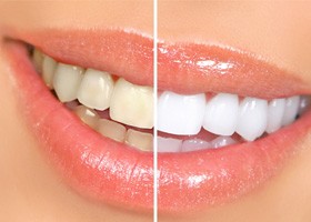 Close up of smile before and after teeth whitening in Oklahoma City