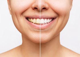 Young woman’s teeth before and after whitening 
