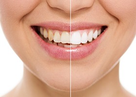 Young woman before and after Zoom! teeth whitening 