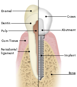 dental implants