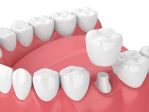 3D illustration of a dental crown 