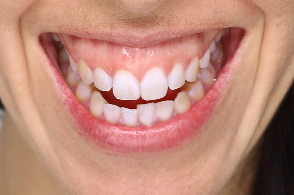 woman with hyperactive upper lip